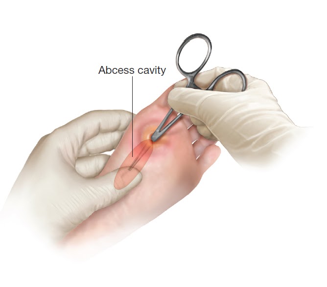 probe to find the abscess tract