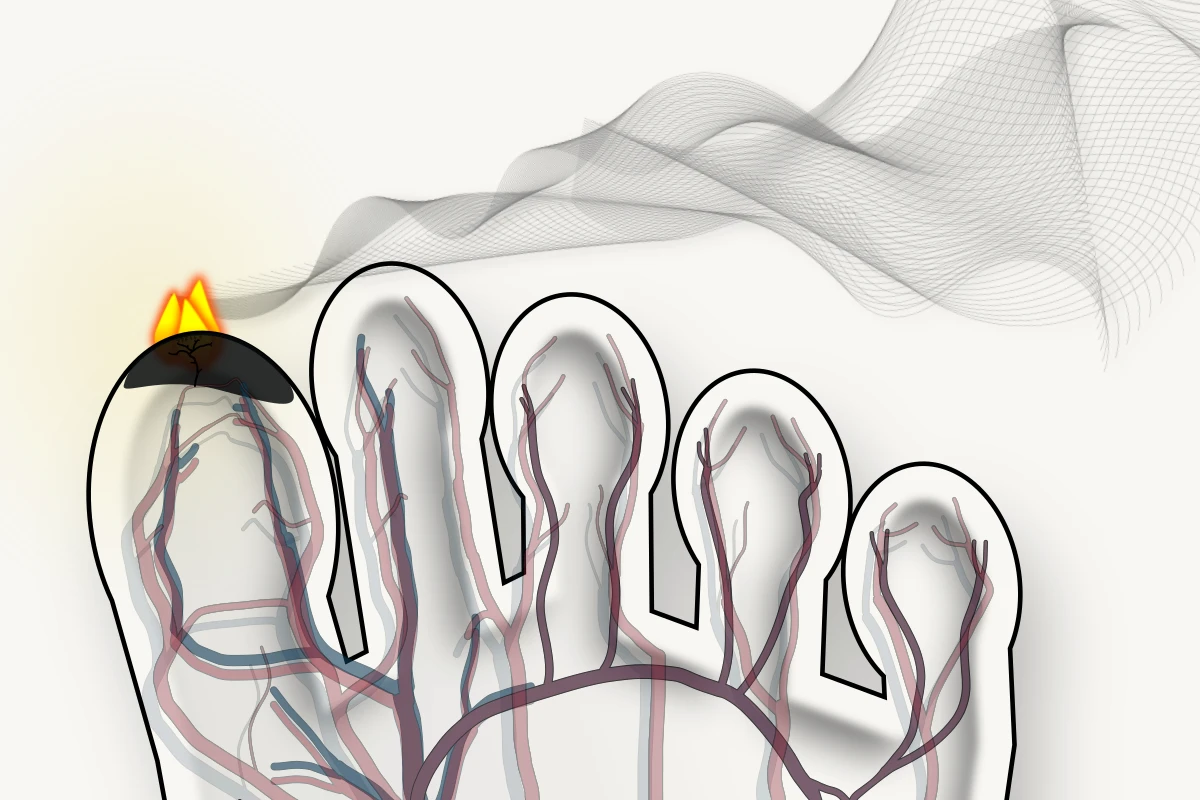 Anatomical illustration of a foot infection represented by flame and smoke above the great toe