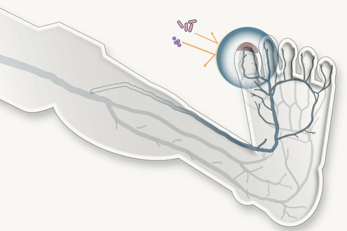 Anatomical illustration of a lower extremity with a force field protecting a great-toe wound from bacteria