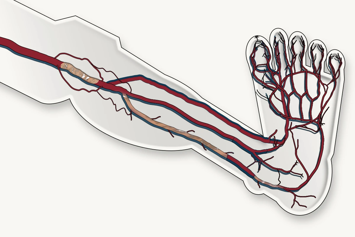 Anatomical illustration of lower-extremity arteries with occlusive disease