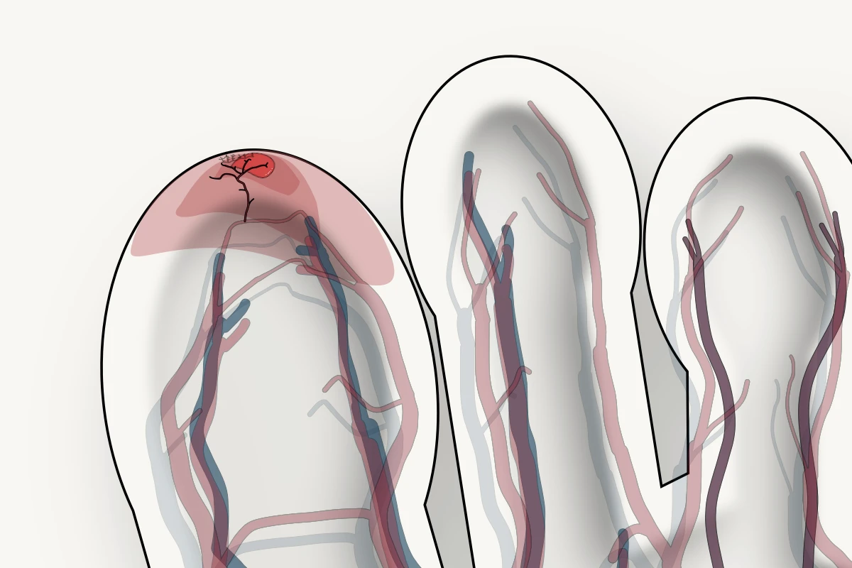 Anatomical illustration of granulation and healing tissue at the great toe