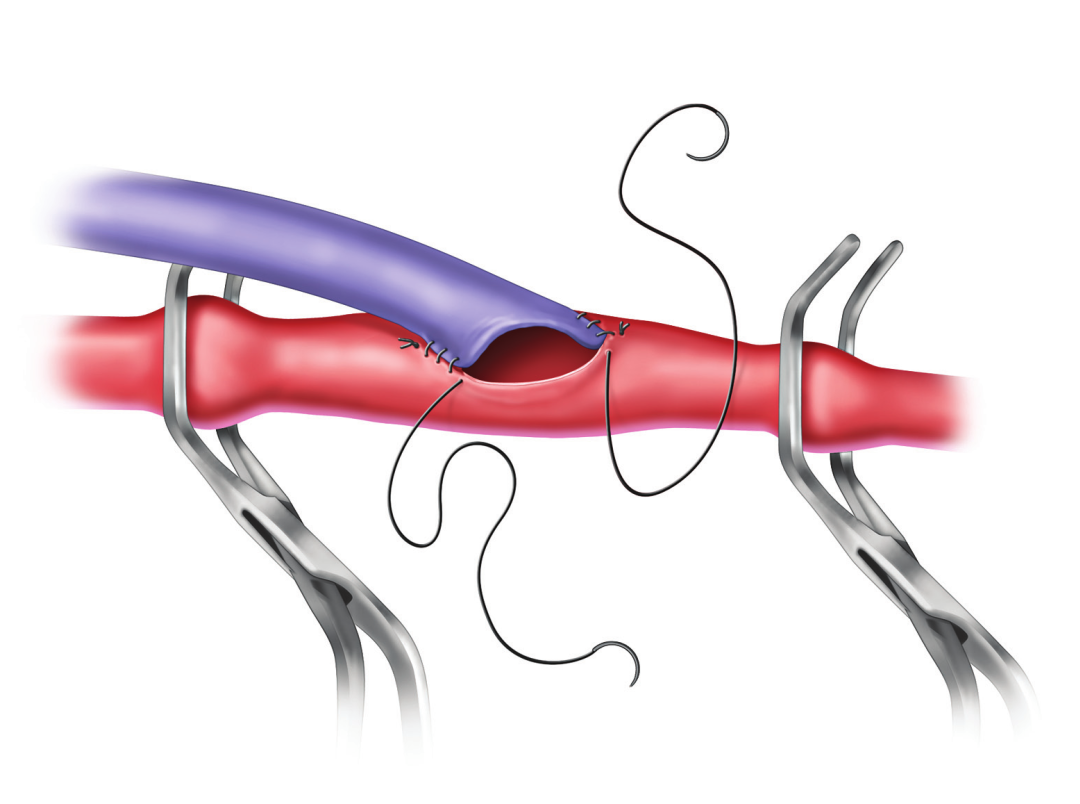 Illustration of the distal anastomosis of a femoropopliteal bypass using an autogenous vein conduit