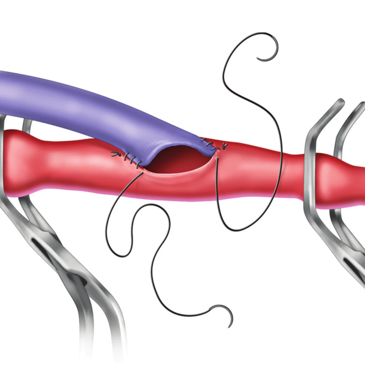 Close view of a vein bypass graft being sutured to an artery