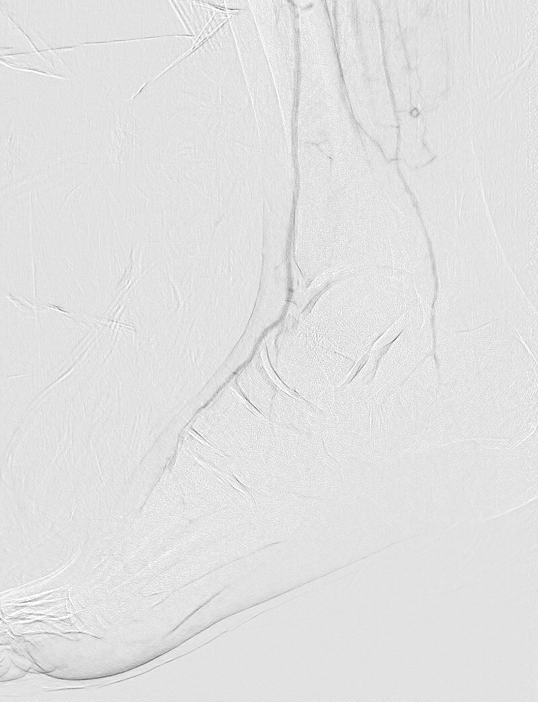 Foot and ankle angiography with hand injection.