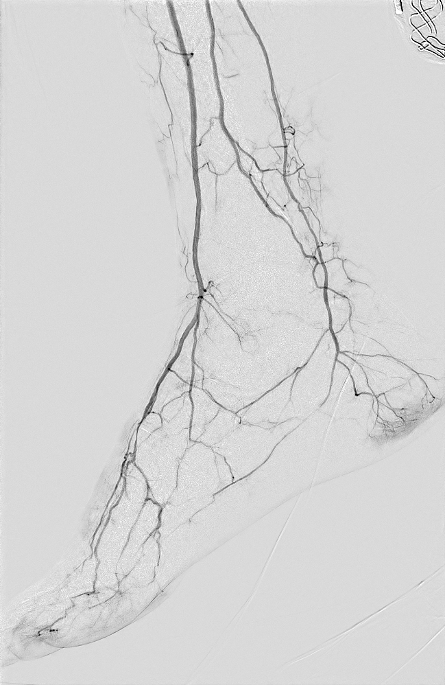 Repeat foot angiography with a power injector.