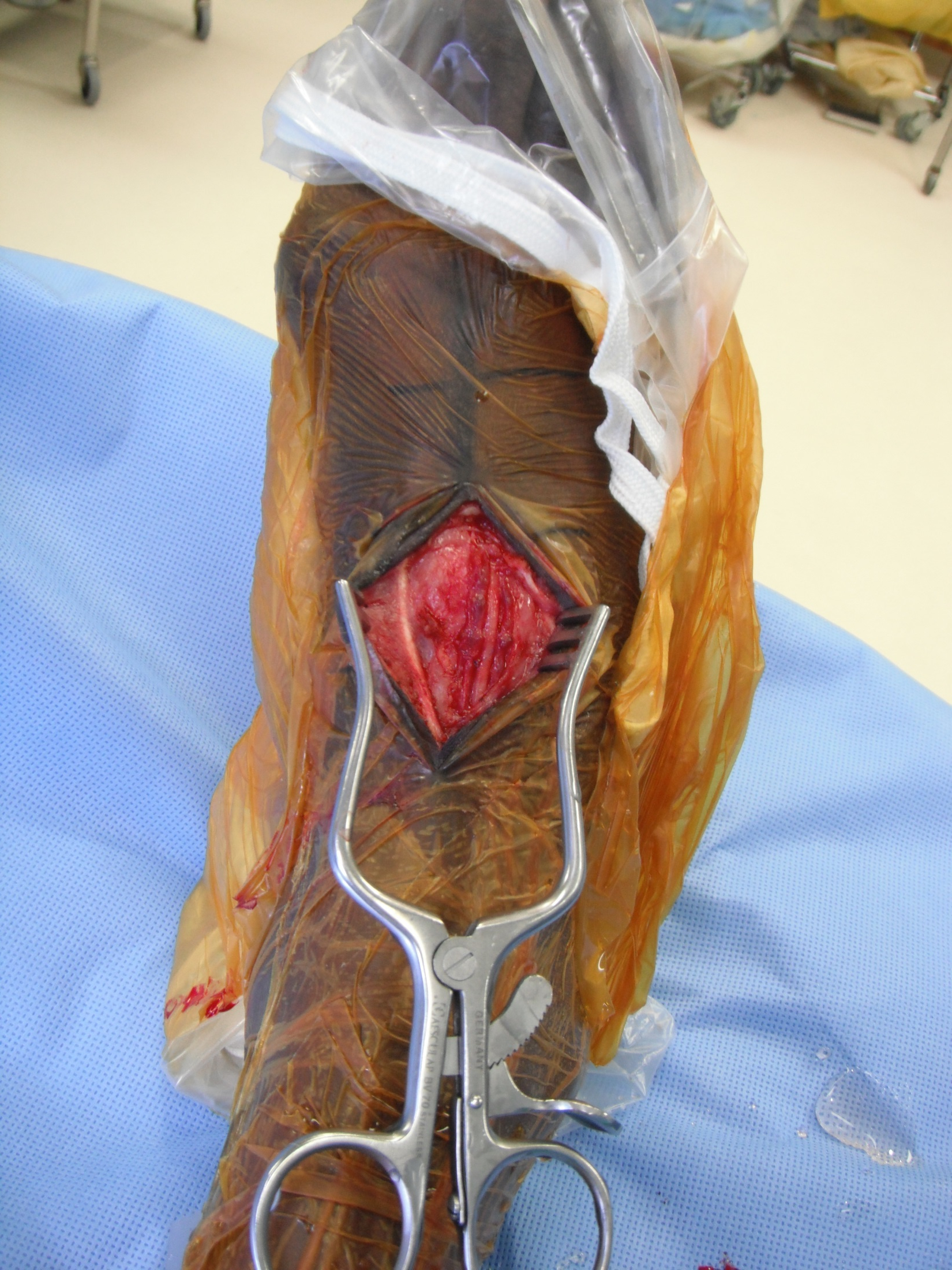 Dorsal foot exposure, overview.