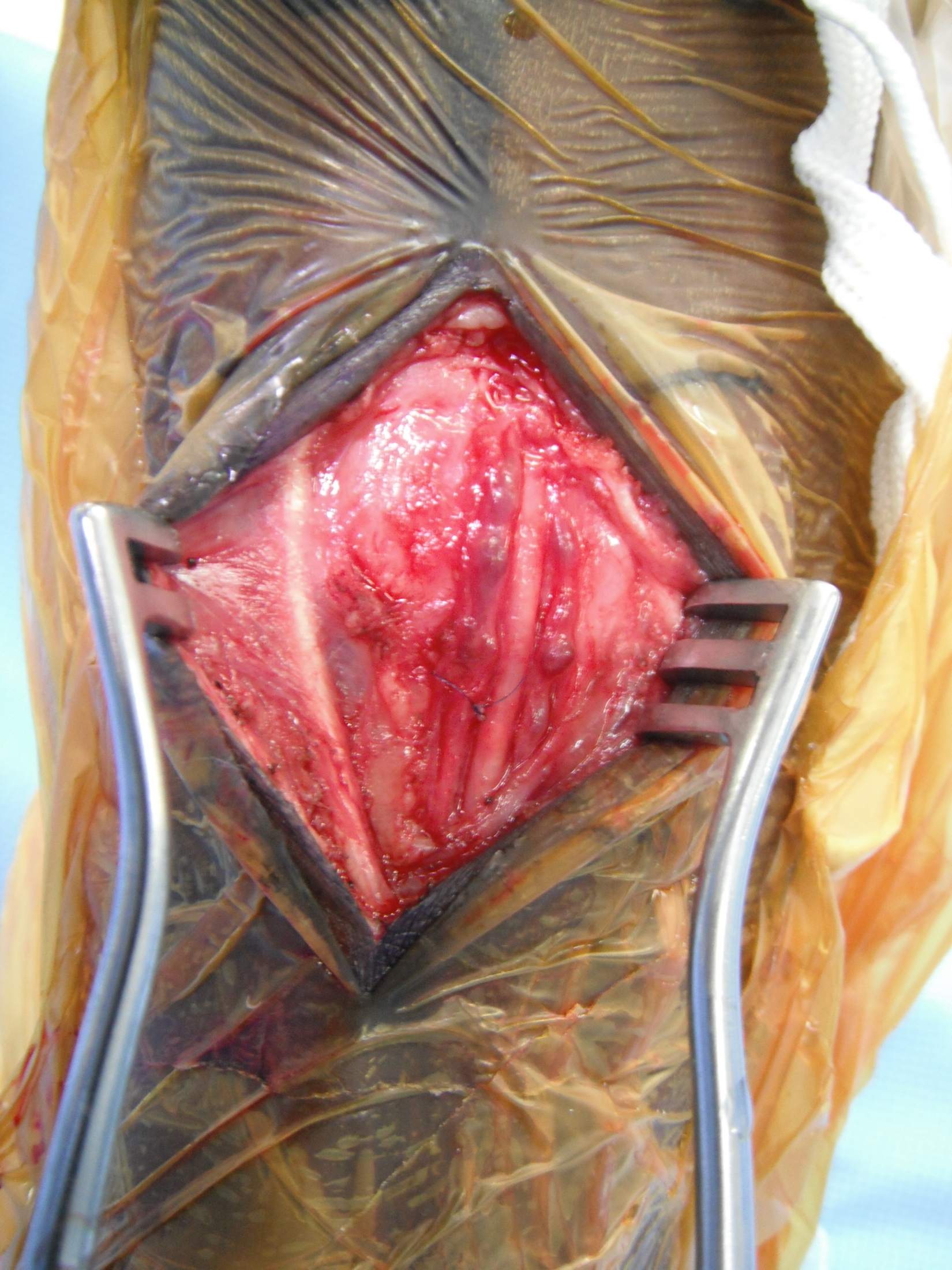 Dorsalis pedis exposure, close-up.
