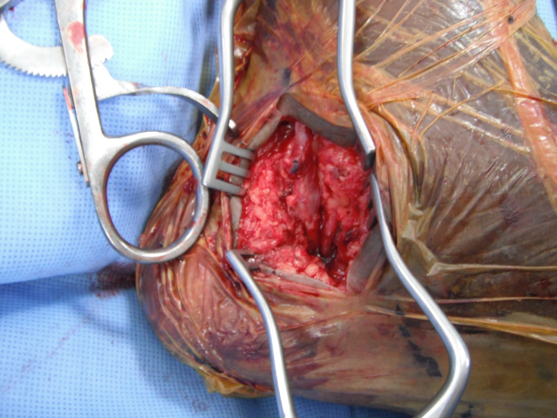 Posterior tibial artery exposure photograph.