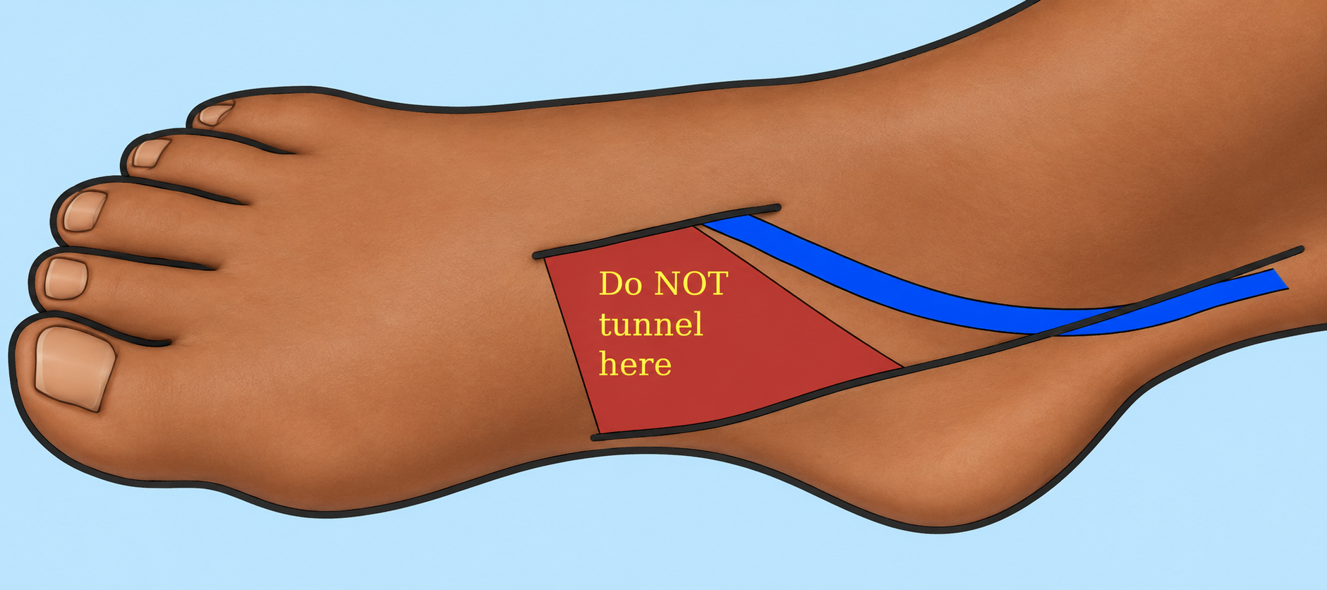 Vein graft tunneling to the cranial end of the dorsalis pedis exposure.
