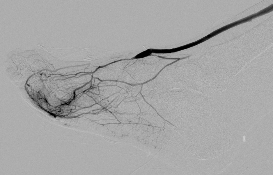 Completion digital subtraction angiogram, first panel.