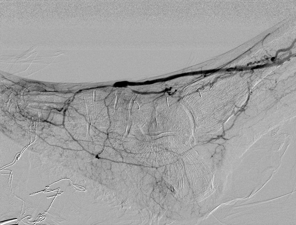 Completion digital subtraction angiogram, second panel.