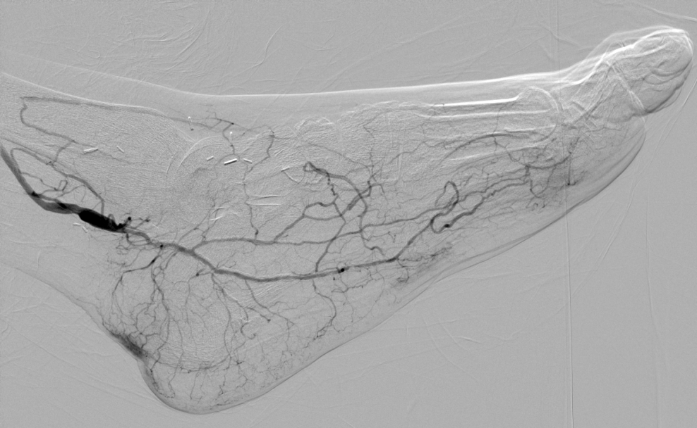 Lateral completion angiogram of a distal posterior tibial bypass.