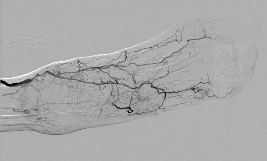 Caudocranial completion angiogram of the distal posterior tibial bypass.