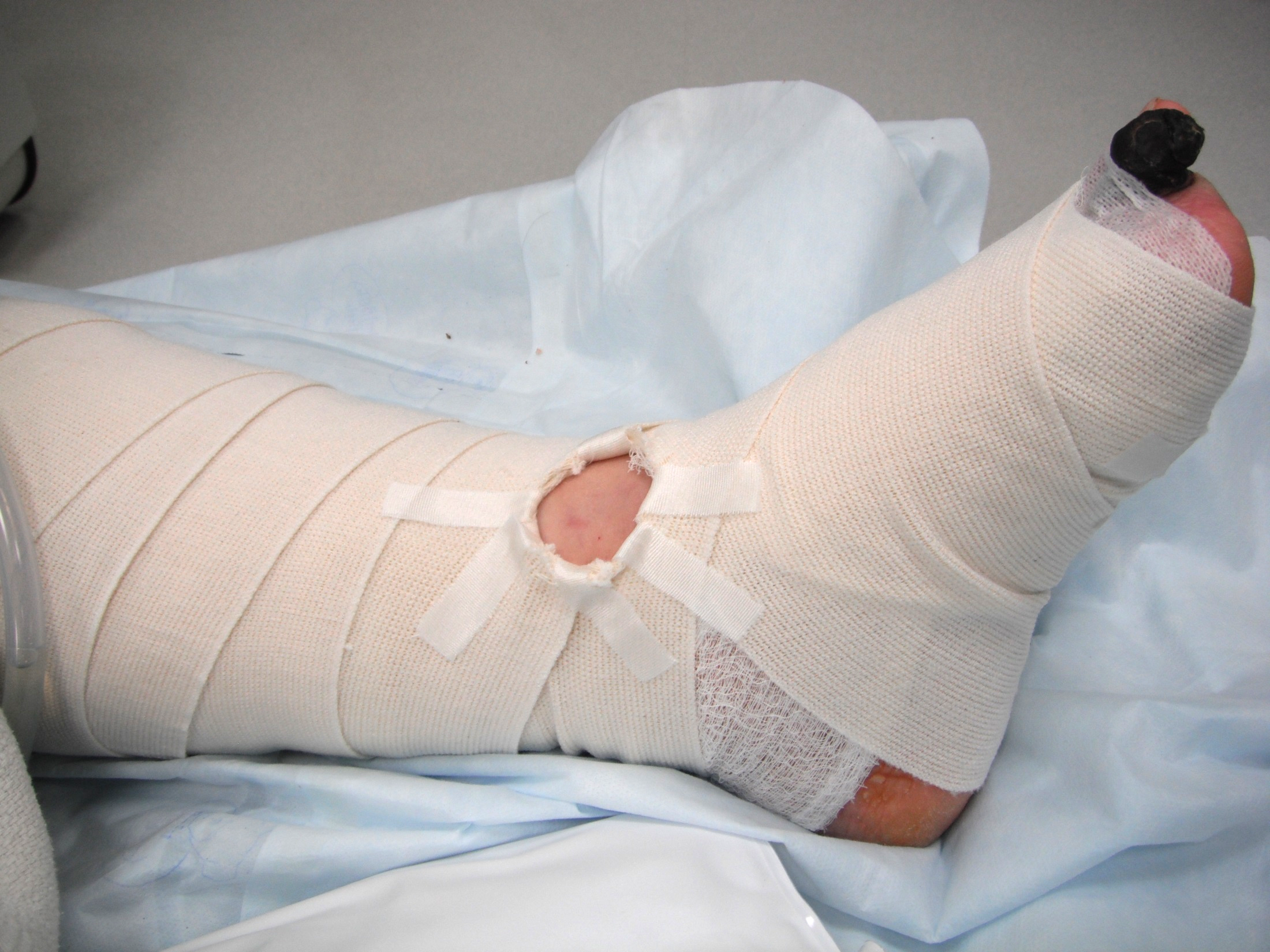 Dorsalis pedis bypass wrap with graft Doppler window.