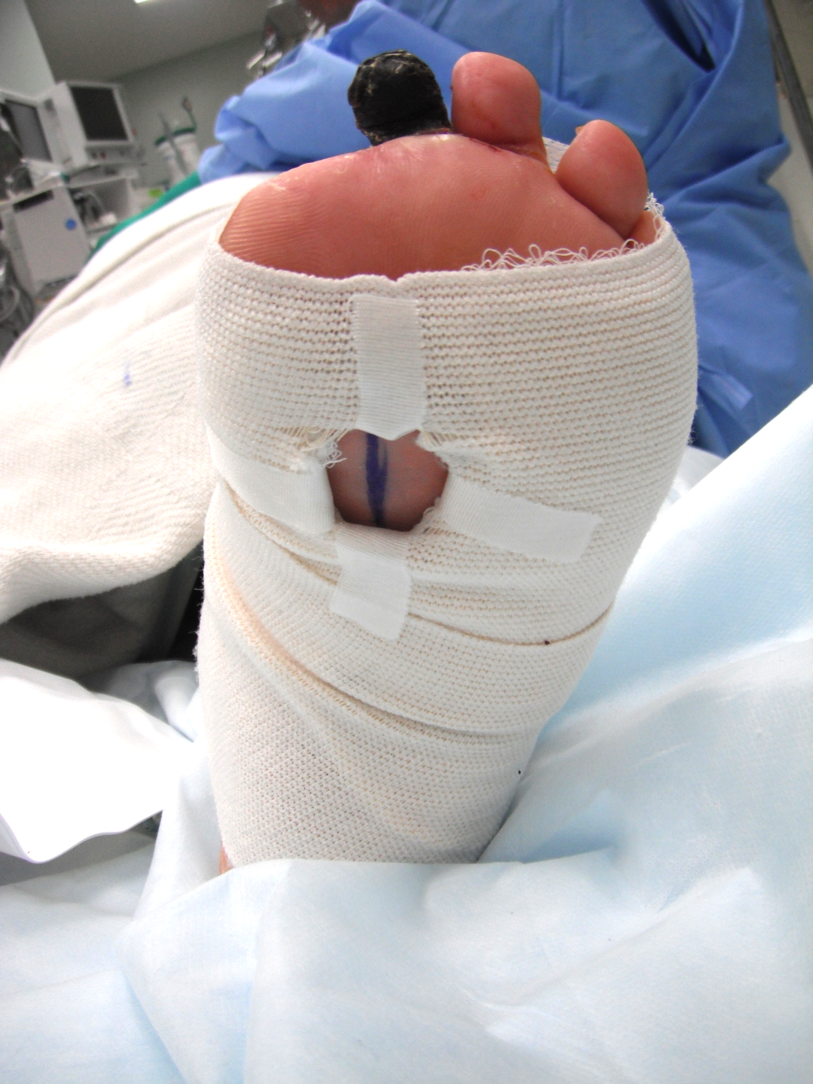 Plantar foot window for Doppler assessment of outflow.