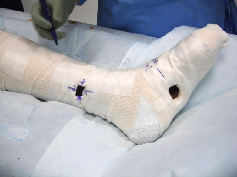 Posterior tibial bypass wrap with graft and outflow windows.